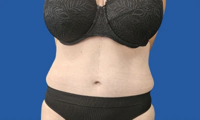 6 months after fleur-de-lis tummy tuck, front view