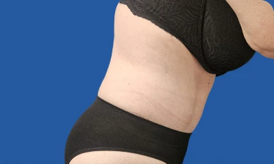 6 months after fleur-de-lis tummy tuck, side view