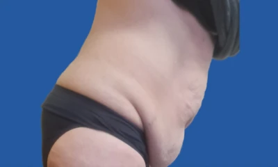 Before fleur-de-lis tummy tuck, side view