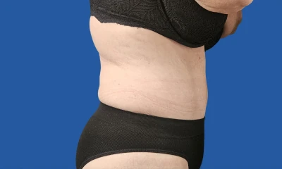 6 months after fleur-de-lis tummy tuck, side view, other side